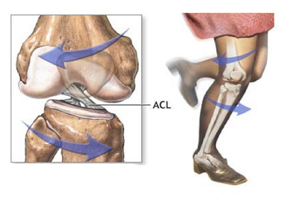 ACL Mechanism of Injury