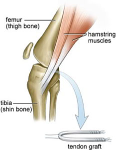 Hamstring Graft for ACL