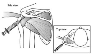 Subacromial Injection