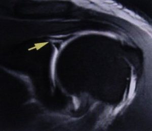 SLAP Tear MRI Arthrogram