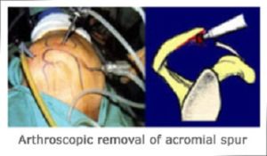 Subacromial Bursitis Decompression Surgery