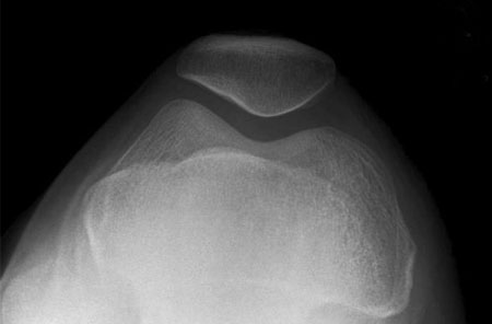 Axial View of Knee