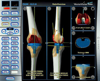 Knee Replacement Navigation System