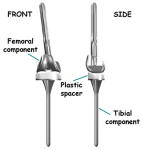 Knee Revision Surgery