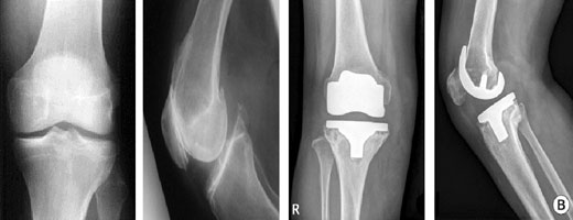 Primary Total Knee Replacement