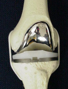 Knee Replacement in Bone Model