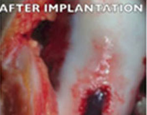 After Implantation