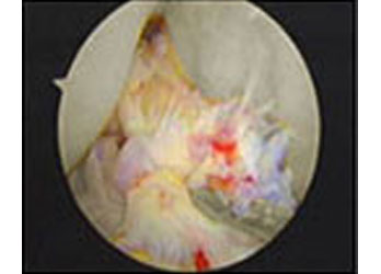 Cruciate ligaments