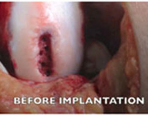 Before Implantation