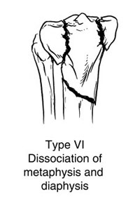 Fracture of both the Condyles that extends downwards to the shaft of the Tibia