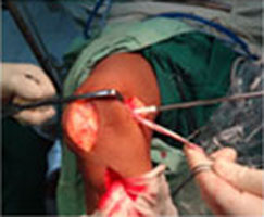 MPFL Tear Surgical Steps