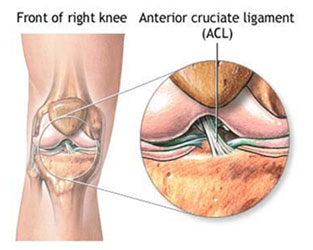 Anterior Cruciate Ligament Tear