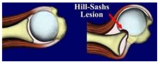 Импрессионный перелом хилл-сакса плечевого сустава. Повреждения хилл сакса головки. Импрессионный перелом головки плечевой кости хилл-сакса. Перелом хилл-сакса плечевой кости кт. Хилл сакса плечевого сустава мрт.