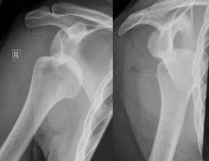Anterior Shoulder Dislocation X-ray