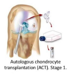 Autologus Chondrocyte Implantation