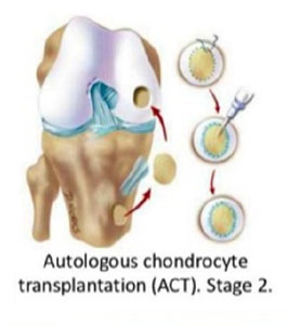 Autologus Chondrocyte Implantation