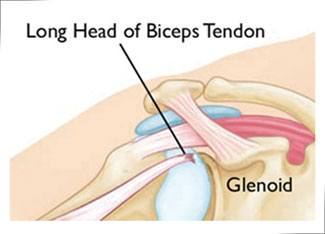 biceps tendon tear