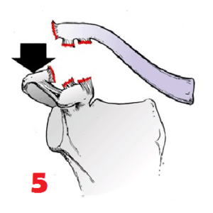 Disjonction Acromio Claviculaire Stage 5