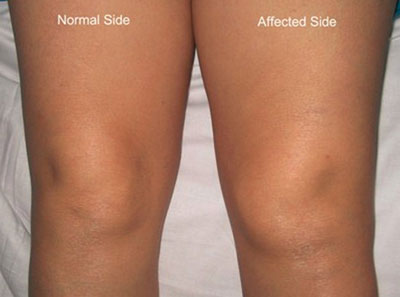Example of Knee Fusion