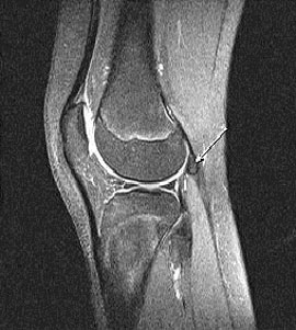 Fabella Knee MRI