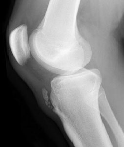 Fabella Knee X-ray