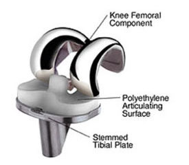 Femoral Component