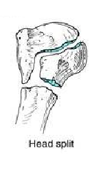 four part fracture of proximal humerus 3