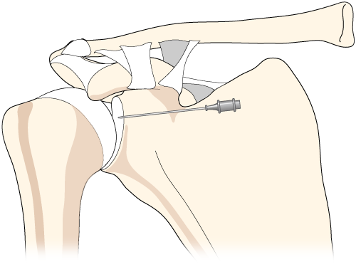 Glenohumeral Injection