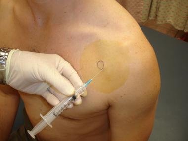 Glenohumeral Joint Steroid Injection