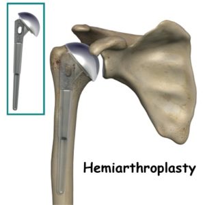  Shoulder Hemiarthroplasty