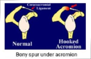 Hooking of the Acromion