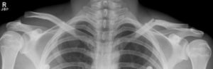 Impacted Clavicle Fracture X-ray