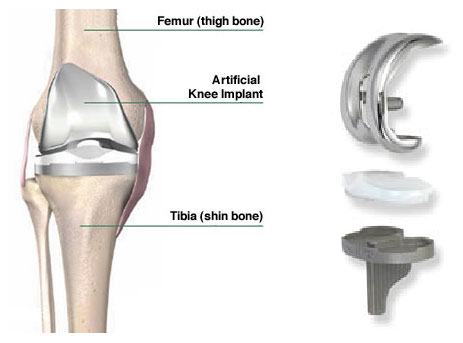  Primary Knee Replacement Implants