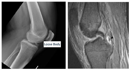 Loose Body in the Knee