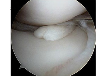 Meniscus Tear