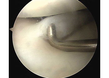 Meniscus Tear