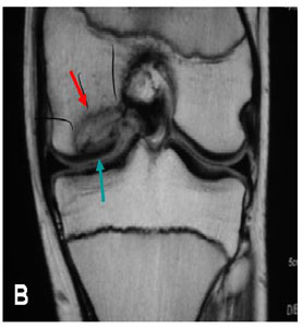 MRI of Arthroscopic Articular Cartilage Repair