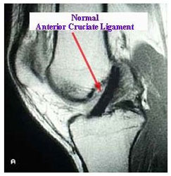 MRI of Normal ACL