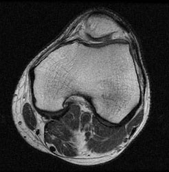 MRI of Normal Knee