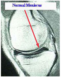 MRI of Normal Meniscus