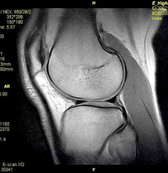 MRI Scan of Knee