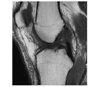 Normal ACL MRI