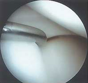 Normal Meniscus