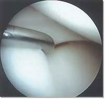 Normal Meniscus