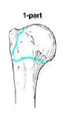 one-part fracture of proximal humerus