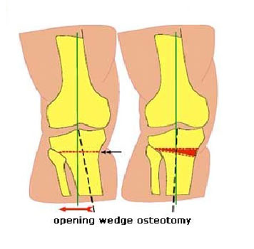 Open Wedge High Tibial Osteotomy