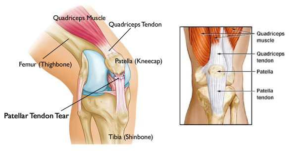 Partial Patellar Tendon Tear