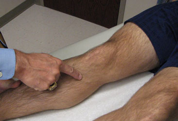 Pes Anserine Bursitis Clinical Test