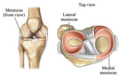 Posterior Horn Medial Meniscus Tear