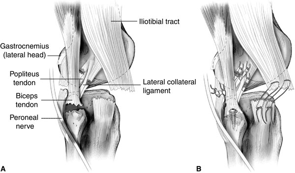 Posterolateral Corner of the Knee